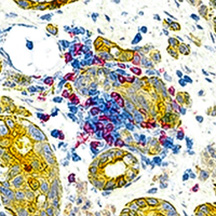 Colorectal Cancer: CD4, CD8, PanCK.
