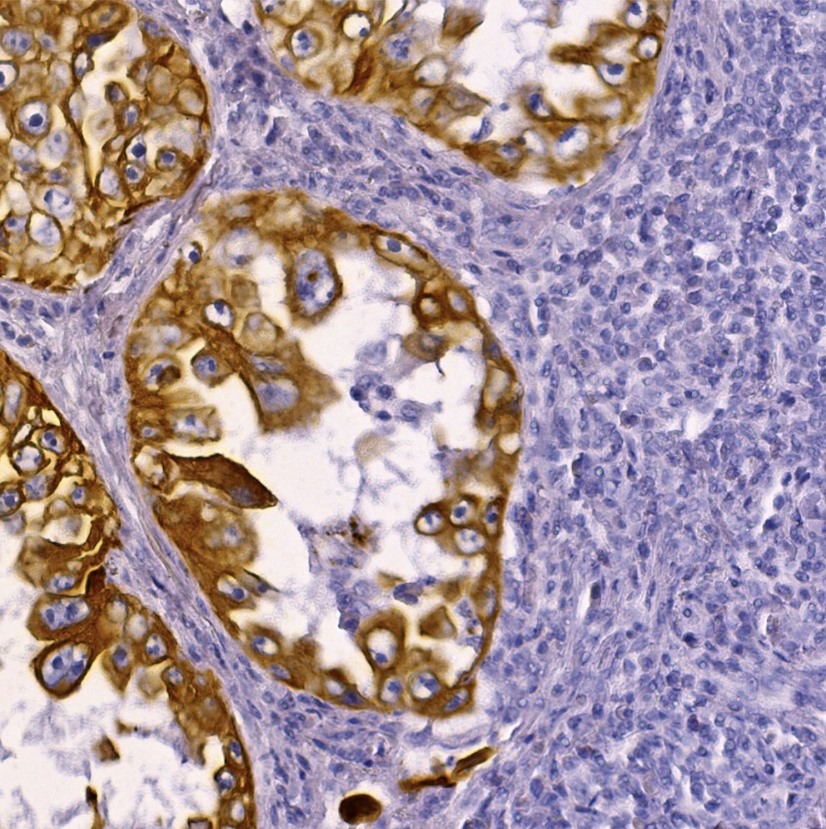 Lung adenocarcinoma stained with anti-PanCK antibody labeled and detected using UTCK-HRP2 Kit and Cell Palette Yellow HRP Chromogen