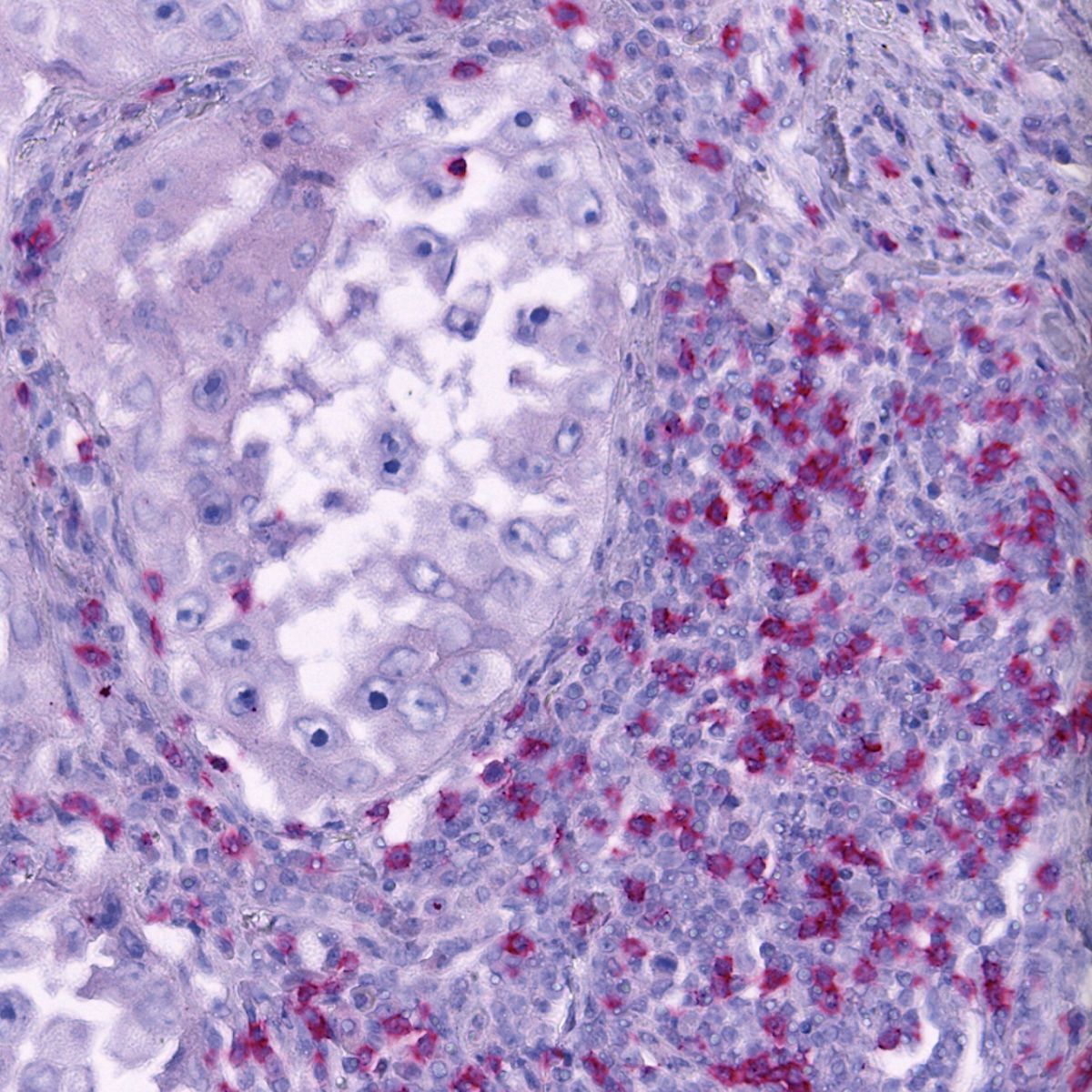 Lung adenocarcinoma stained with anti-CD8 antibody labeled and detected using UTCK-AP1 Kit and Cell Palette Red AP chromogen