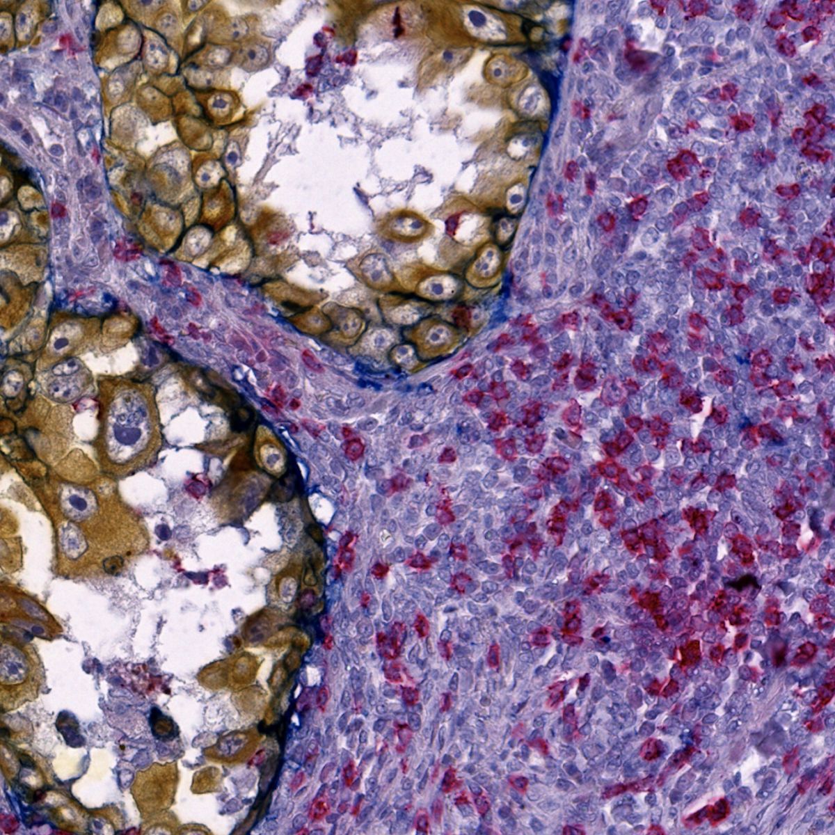 Lung adenocarcinoma stained with anti-CD8, anti-PD-L1 and anti-PanCK antibodies labeled and detected using UTCK-AP1, UTCK-HRP1 & UTCK-HRP2 Kits and Cell Palette Red AP, Blue HRP and Yellow HRP chromogens