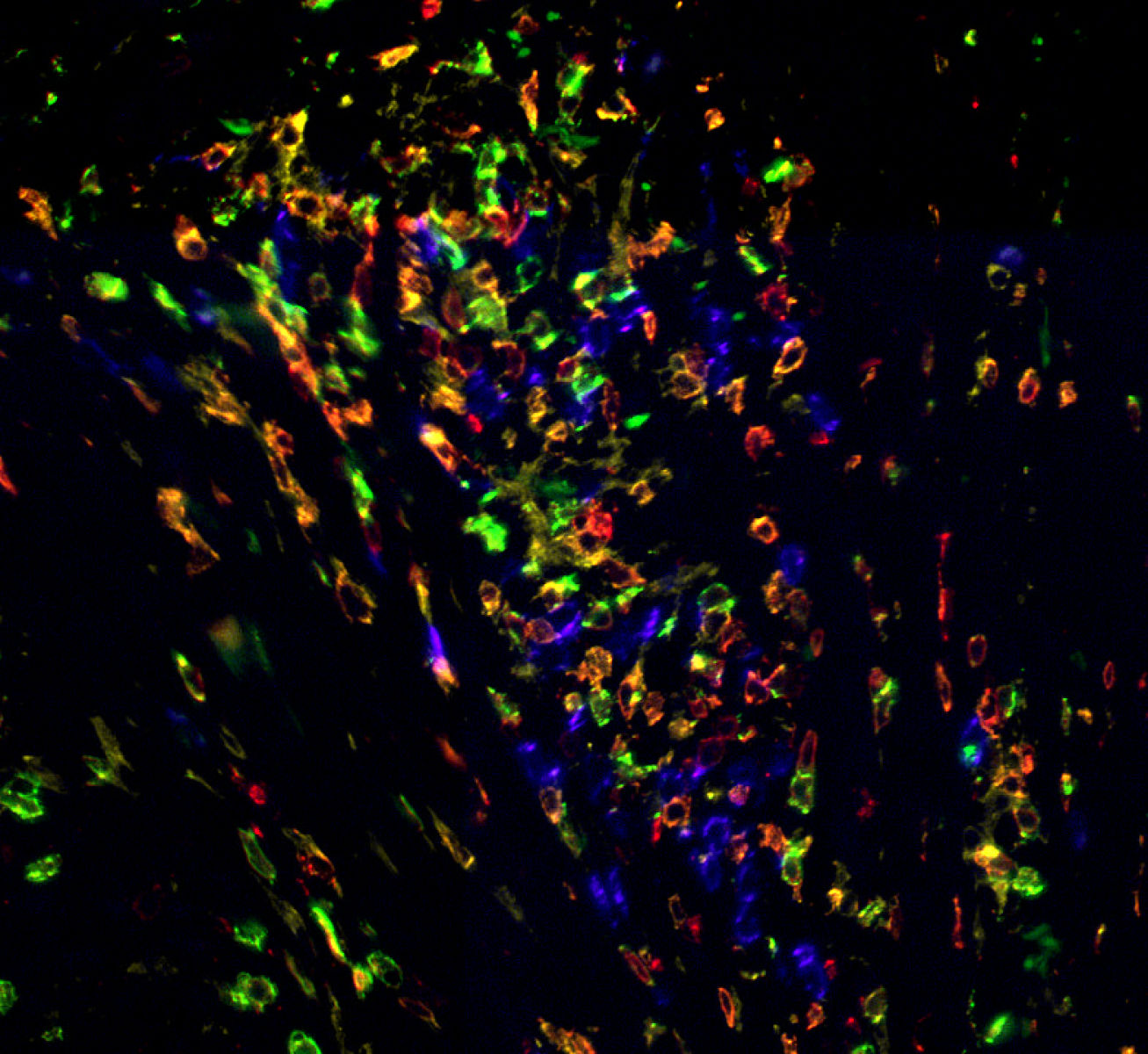 Bladder transitional cell carcinoma biopsy stained manually with HI-1A UltraPlex panel: CD3 (red), CD4 (yellow), CD8 (green), CD20 (purple). 20X magnification.