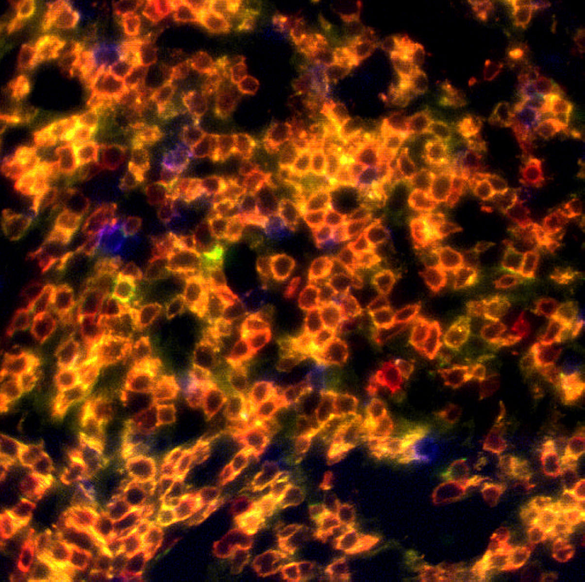 Hodgkin's lymphoma biopsy stained manually with HI-1A UltraPlex panel: CD3 (red), CD4 (yellow), CD8 (green), CD20 (purple). 20X magnification.