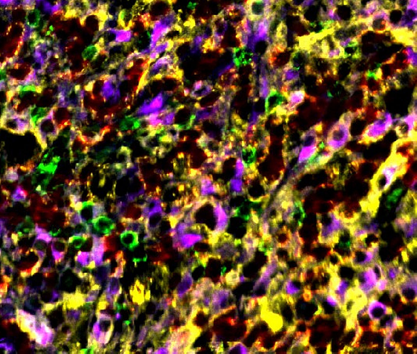 Hodgkins� lymphoma biopsy stained manually with HI-5A UltraPlex panel: CD8 (green), CD68 (purple), PD-1 (red), PD-L1 (yellow). 20X magnification