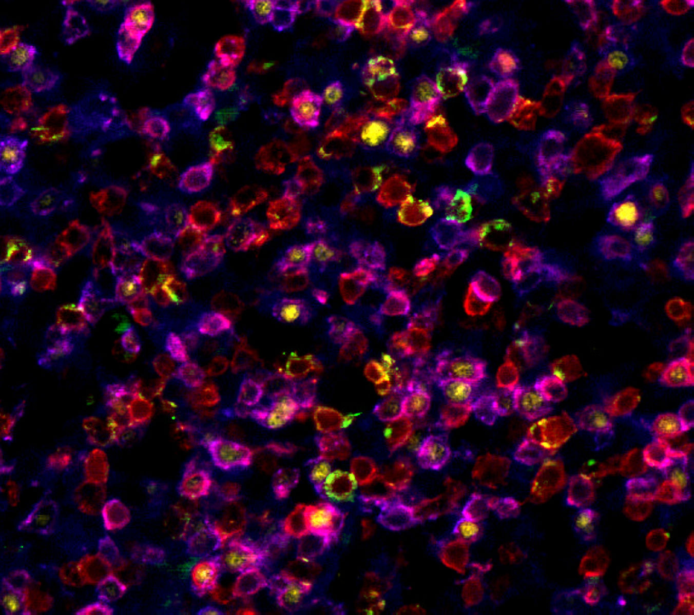 Anaplastic large cell lymphoma biopsy � lymph node - stained manually with HI-6A UltraPlex panel: CD3 (red), FoxP3 (yellow), CD8 (green), CD4 (purple). 20X magnification.
