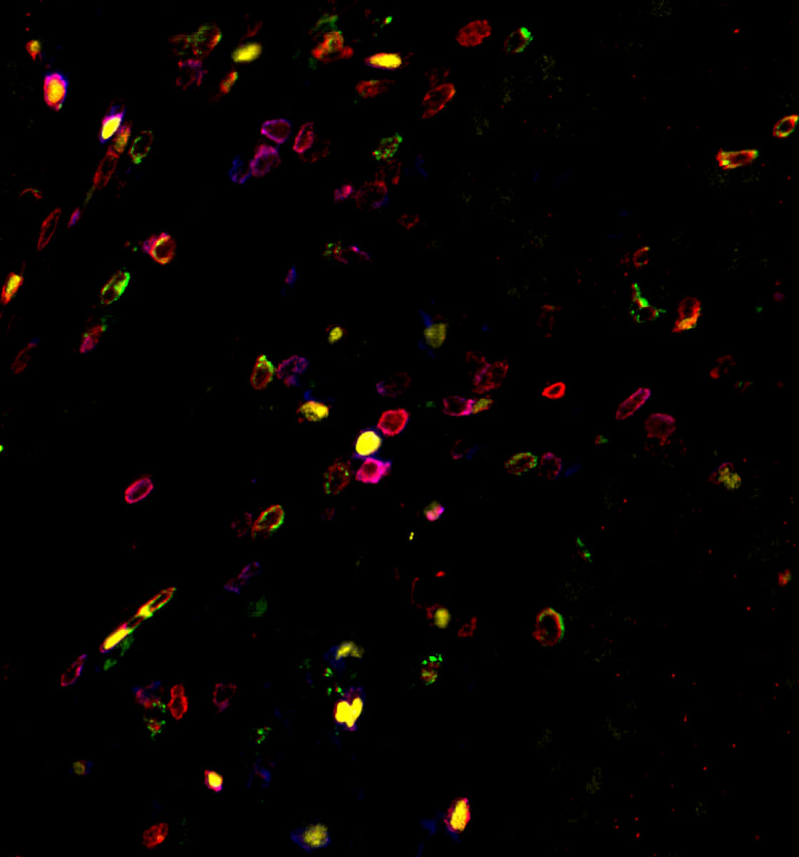 Endometriod adenocarcinoma biopsy - stained manually with HI-6A UltraPlex panel: CD3 (red), FoxP3 (yellow), CD8 (green), CD4 (purple). 20X magnification.